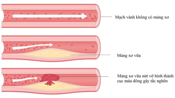 Cục máu đông được hình thành do nứt vỡ mảng xơ vữa bên trong lòng mạch máu